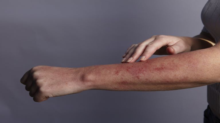 آفات جلدية تشير ملاحظتها إلى “المراحل المبكرة من الخرف”